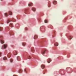 andes variant hantavirus — NL news