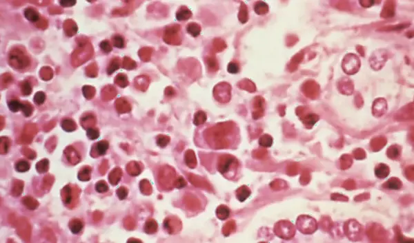 andes variant hantavirus — NL news